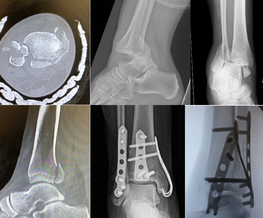 Fixation Of Posterior Malleolus Fractures Literature Review And